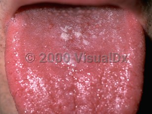 Clinical image of Oral candidiasis