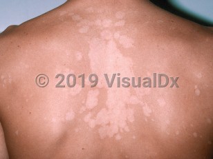 Clinical image of Tinea versicolor - imageId=177139. Click to open in gallery.  caption: 'Flat, scaly hypopigmented papules and plaques on the back.'