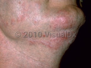 Clinical image of Tinea barbae - imageId=177152. Click to open in gallery.  caption: 'A close-up of scaly and crusted pink plaques in the beard area.'