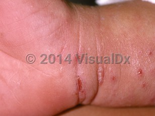 Clinical image of Scabies