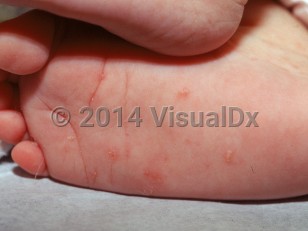 Clinical image of Scabies (pediatric)