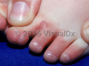 Clinical image of Infantile digital fibromatosis - imageId=1778736. Click to open in gallery.  caption: 'Smooth pink nodules on the toes.'
