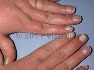 Clinical image of Leukonychia - imageId=178332. Click to open in gallery.  caption: 'Apparent leukonychia, showing pallor of some of the fingernails.'
