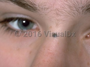 Clinical image of Deep penetrating nevus - imageId=178567. Click to open in gallery.  caption: 'A deep grayish-blue and brown papule at the glabella.'