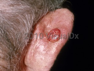 Clinical image of Cutaneous squamous cell carcinoma - imageId=178723. Click to open in gallery. 
