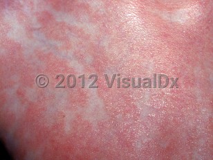 Clinical image of Juvenile pityriasis rubra pilaris - imageId=1787397. Click to open in gallery.  caption: 'A close-up of well-demarcated orange-pink plaques with fine scale.'