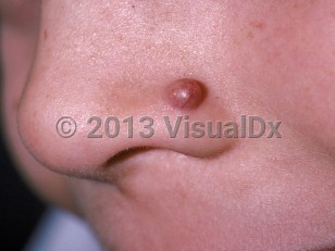 Clinical image of Pilomatricoma - imageId=179264. Click to open in gallery.  caption: 'A deep red papule with overlying telangiectasias on the nose.'