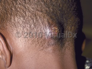 Clinical image of Kerion - imageId=180029. Click to open in gallery.  caption: 'A faintly violaceous nodule with superimposed pustules on the occipital scalp.'