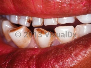 Clinical image of Late congenital syphilis - imageId=1805532. Click to open in gallery.  caption: 'Hutchinson teeth (notched incisors).'