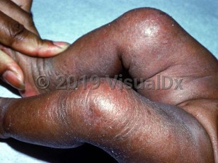 Clinical image of Essential fatty acid deficiency - imageId=1814748. Click to open in gallery.  caption: 'Diffuse erythema and scaling on the legs.'