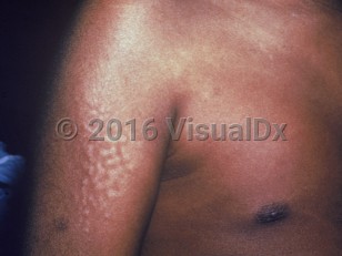 Clinical image of Hunter syndrome