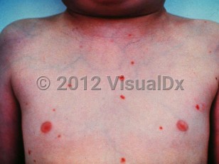 Clinical image of Sinus histiocytosis with massive lymphadenopathy - imageId=1819171. Click to open in gallery.  caption: 'Scattered bright red papules and plaques on the trunk.'