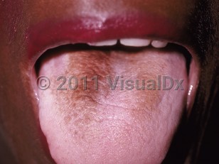 Clinical image of Hairy tongue - imageId=182267. Click to open in gallery.  caption: 'Brownish discoloration on the dorsal tongue.'