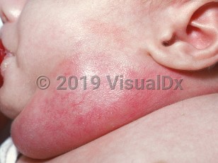 Clinical image of Abscess of the newborn - imageId=1823631. Click to open in gallery.  caption: 'A giant, deep red nodule on the neck from <i>Staphylococcus aureus</i>.'
