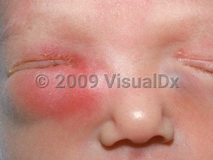 Clinical image of Neonatal dacryocystitis - imageId=1834943. Click to open in gallery.  caption: 'Marked infraorbital edema and erythema and milder similar supraorbital changes with overlying crusting on the right, and a smooth bluish papule on the left infraorbital skin.'