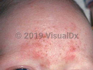 Clinical image of Eosinophilic pustular folliculitis in infancy