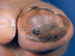 Clinical image of Acral lentiginous melanoma