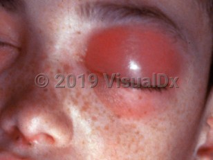 Clinical image of Cavernous sinus thrombosis - imageId=1850125. Click to open in gallery. 
