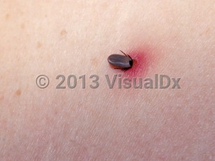 Clinical image of Tick bite - imageId=1856076. Click to open in gallery.  caption: 'A partially engorged, embedded tick with surrounding bright red erythema.'