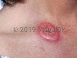 Clinical image of Acute febrile neutrophilic dermatosis