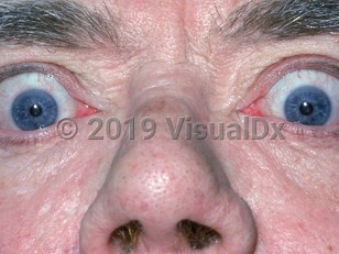 Clinical image of Graves ophthalmopathy