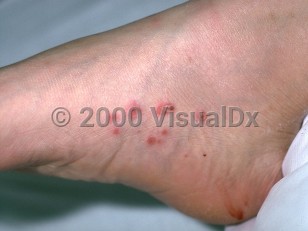 Clinical image of Disseminated candidiasis - imageId=186211. Click to open in gallery.  caption: 'A cluster of red papules, some with overlying pustules and others with central early crusts, on the foot of a patient with end stage renal disease.'