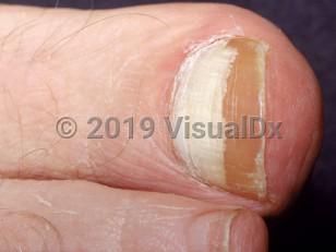 Clinical image of Proximal subungual onychomycosis - imageId=1862878. Click to open in gallery. 