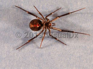 Organism image of Widow spider envenomation - imageId=1866553. Click to open in gallery.  caption: 'A black widow spider (<i>Latrodectus mactans</i>).'