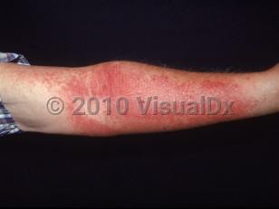 Clinical image of Recluse spider envenomation - imageId=1866747. Click to open in gallery.  caption: 'A giant erythematous plaque with overlying crusting and similar surrounding papules on the arm.'