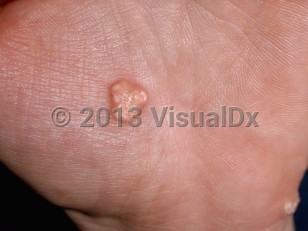Clinical image of Calcinosis cutis