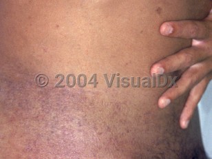 Clinical image of Human T-cell lymphotropic virus type 1 - imageId=1878080. Click to open in gallery.  caption: 'Violaceous macules and patches on the back and flank.'