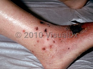 Clinical image of Eosinophilic granulomatosis with polyangiitis - imageId=187886. Click to open in gallery.  caption: 'Several tiny, punched-out, crusted ulcers around the ankle and some larger ulcers with overlying eschars and surrounding erythema on the dorsal foot and lower shin.'