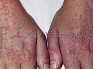 Clinical image of Flat wart - imageId=1881660. Click to open in gallery.  caption: 'Many discrete, pink and light brown, flat-topped, verrucous papules scattered over the dorsal hands. Note the linear arrays of warts indicative of autoinoculation.'