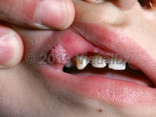 Clinical image of Oral mucosal wart - imageId=1883067. Click to open in gallery.  caption: 'A moist, pink and whitish, verrucous papule on the labial mucosa.'