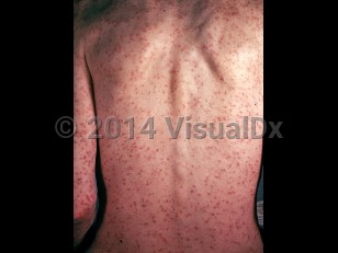Clinical image of Colorado tick fever - imageId=1890149. Click to open in gallery.  caption: 'Widespread deeply erythematous macules and papules on the back and arms.'