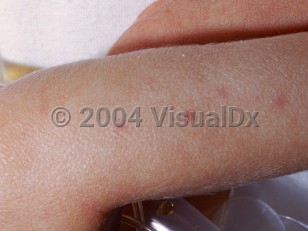 Clinical image of Cytomegalovirus infection of newborn - imageId=1893590. Click to open in gallery.  caption: 'Reddish papules on the arm ("blueberry muffin" lesions associated with cytomegalic inclusion disease).'
