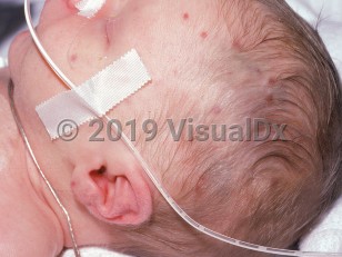Clinical image of Congenital rubella - imageId=1896658. Click to open in gallery.  caption: 'Reddish and violaceous macules and papules on the head and ear ("blueberry muffin" lesions associated with cytomegalic inclusion disease).'