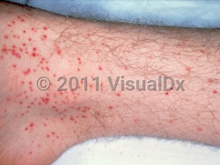 Clinical image of Atypical measles