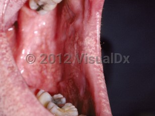 Clinical image of Fordyce spots - imageId=190784. Click to open in gallery.  caption: 'Pinpoint, discrete and confluent, yellow papules on the lower lip and at the oral commissure.'