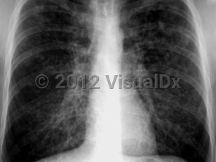 Imaging Studies image of Varicella pneumonia - imageId=1909872. Click to open in gallery.  caption: '<span>PA radiograph of a patient with varicella pneumonia showing widespread poorly defined nodules</span>.'