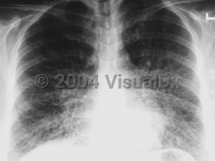 Imaging Studies image of Hantavirus pulmonary syndrome