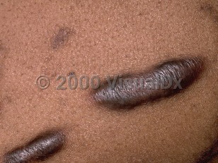 Clinical image of Keloid - imageId=191241. Click to open in gallery.  caption: 'A close-up of two linear, hyperpigmented keloidal plaques.'