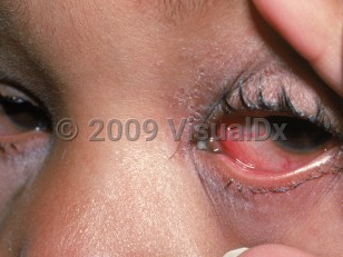 Clinical image of Viral conjunctivitis