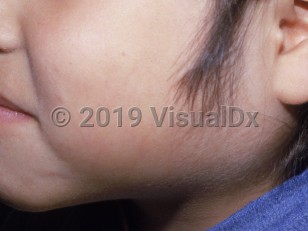 Clinical image of Mumps