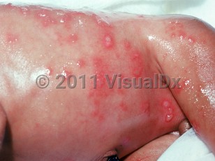 Clinical image of Neonatal herpes simplex virus