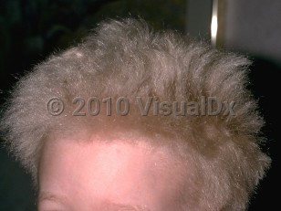 Clinical image of Uncombable hair syndrome