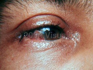 Clinical image of American trypanosomiasis - imageId=1925103. Click to open in gallery.  caption: 'Marked right periorbital edema and erythema, as well as conjunctival injection.'