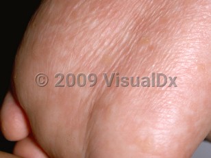 Clinical image of Naegeli syndrome - imageId=192511. Click to open in gallery.  caption: 'Punctate hyperkeratotic papules and effacement of dermatoglyphics on the sole.'