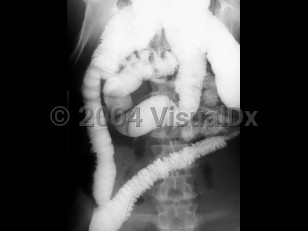 Imaging Studies image of Amebic colitis
