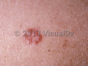 Clinical image of Sarcoidosis - imageId=192732. Click to open in gallery.  caption: 'A close-up of a cluster of smooth reddish-brown papules arranged in an annulus.'